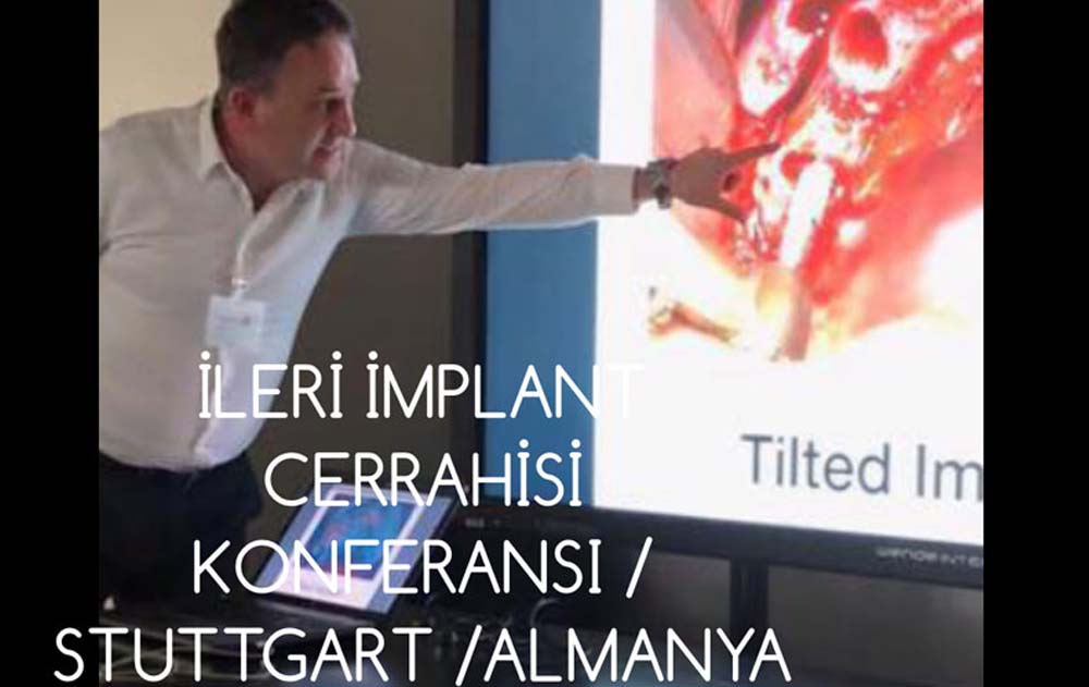 Dikişli İmplantın Önemi