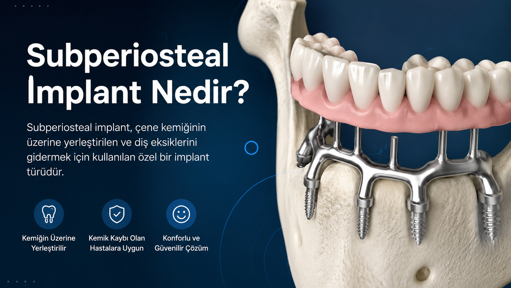 Subperiosteal implant nedir ve kimler için uygundur